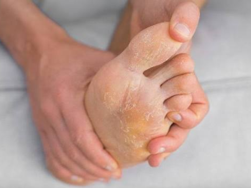 Fungal Infection in Feet