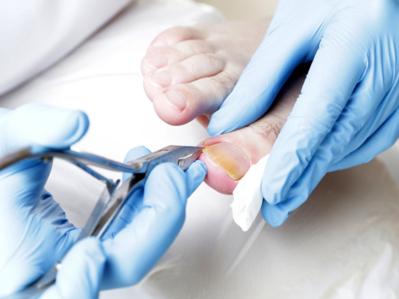 Toenail Care Tips