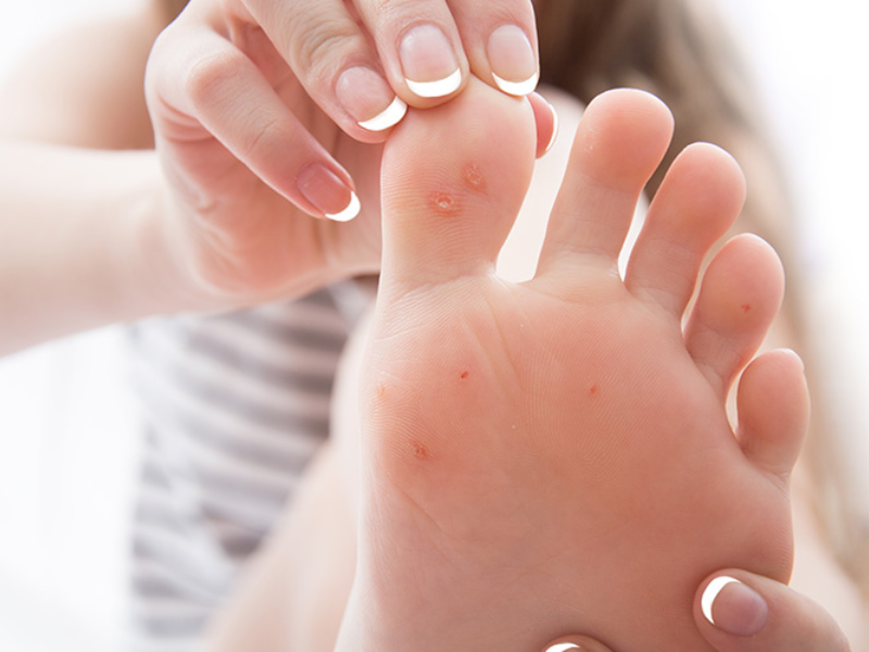 Corns and Calluses Treatment in Delhi
